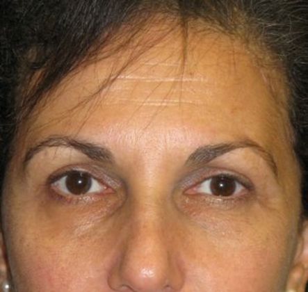 After Brow Lift